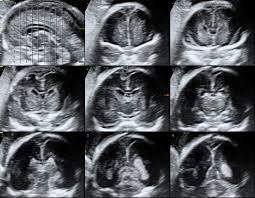 Neurosonography